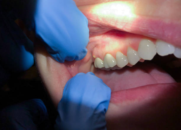 Best Urgent Care for Lost Fillings or Crowns in Chesterfield, SC